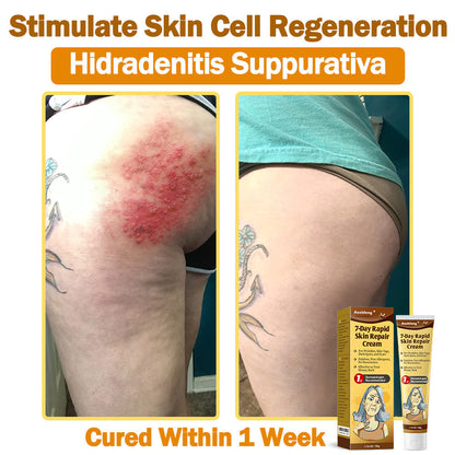 Only 6 tubes left! We're offering you an extra 30% off! 𝐀𝐞𝐞𝐡𝐟𝐞𝐧𝐠®🌈 Recommended by dermatologists, 4-5 tubes will restore your perfect skin! If you miss this opportunity, you'll have to wait until next year to buy!